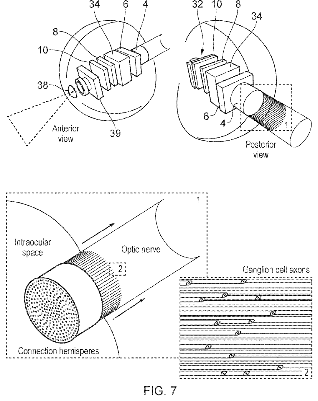 Patent drawing of an implant inside the eye shown from front and back, and a magnified view of a microwire array entering the optic nerve alongside parallel ganglion cell axons.
